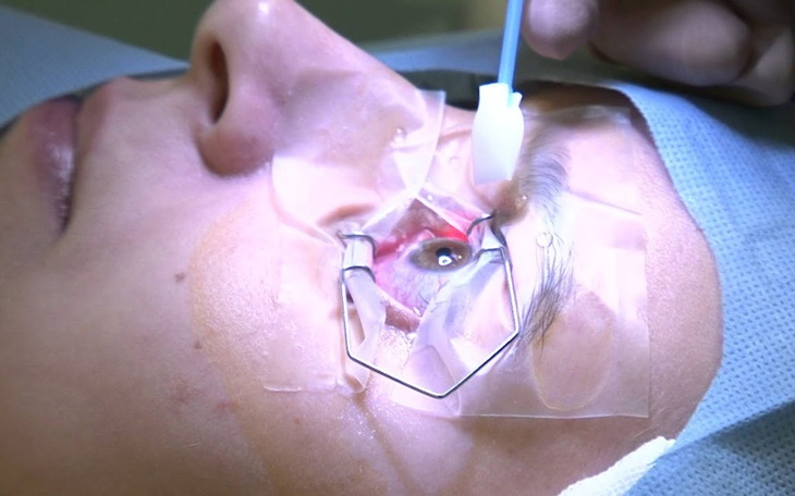 Zbiórka Operacja oczu - astymgatyzm - zdjęcie główne