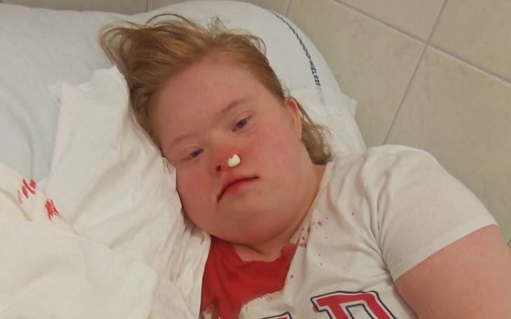 Młoda dziewczyna leży w szpitalu, z widocznymi obrażeniami na twarzy.