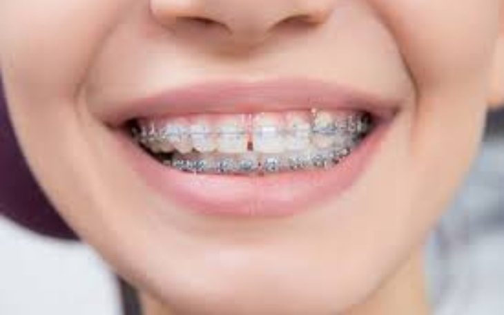 Zbiórka -- Aparat na zęby -- - zdjęcie główne