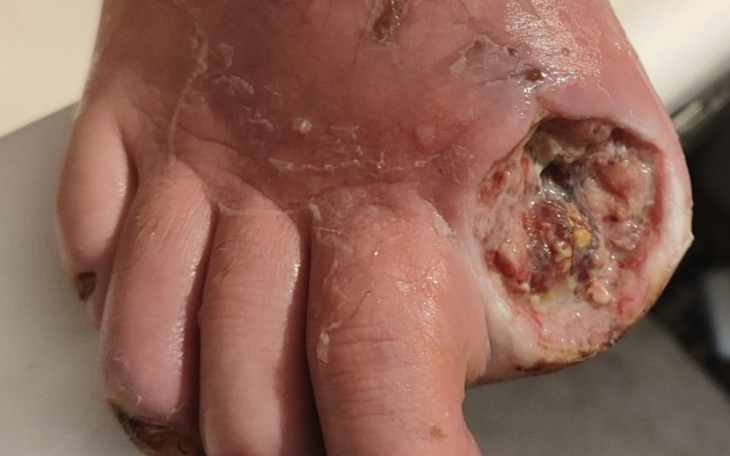 Zraniona stopa z widocznymi ranami.