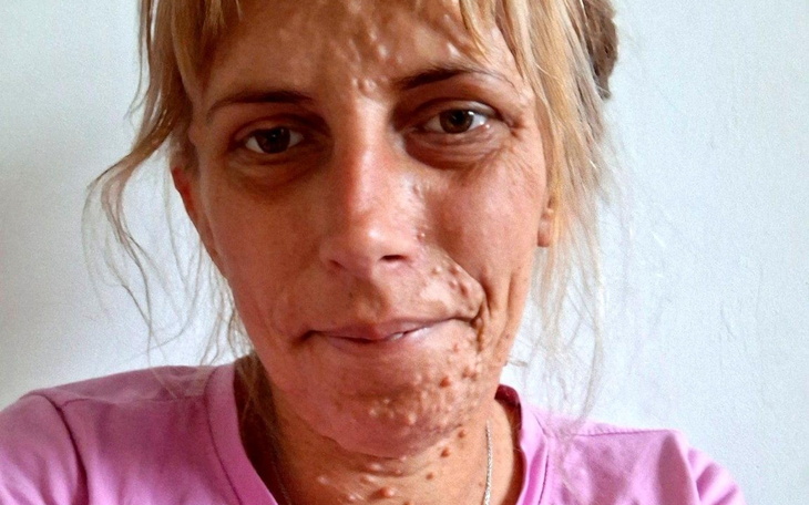 Portret kobiety z widocznymi zmianami skórnymi, uśmiechającej się do kamery.