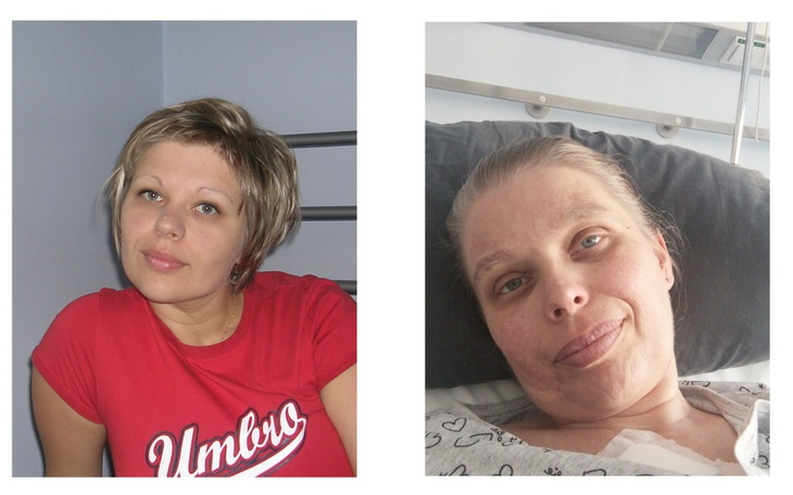 Zbiórka Rehabilitacja Kasi z Rakiem - zdjęcie główne