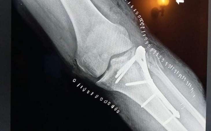 Zbiórka Zbiórka pieniędzy dla Łukasza - zdjęcie główne