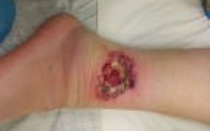 Zbiórka na chorą noge - zdjęcie główne