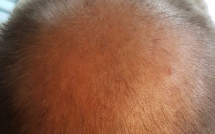 Zbiórka Na przeszczep włosów - zdjęcie główne