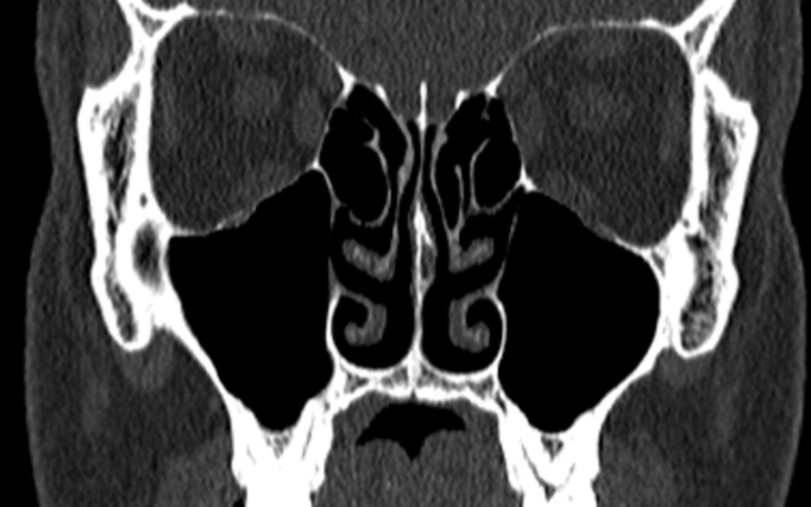 Zdjęcie tomografii komputerowej przedstawiające zatoki.