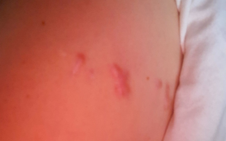 Zbliżenie na skórę z bliznami, kontrowersyjny temat.