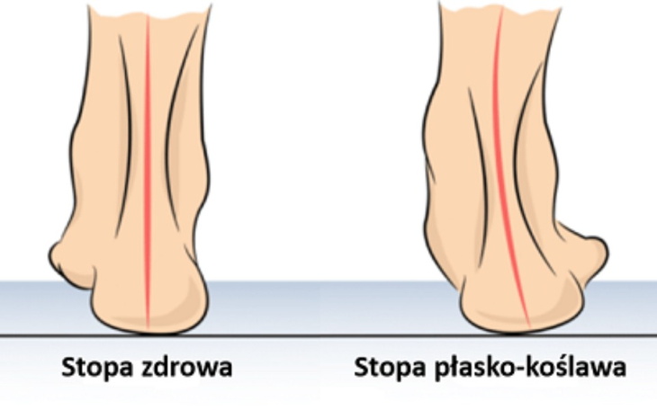 Zbiórka Zabieg na stopy koślawe bolące - zdjęcie główne