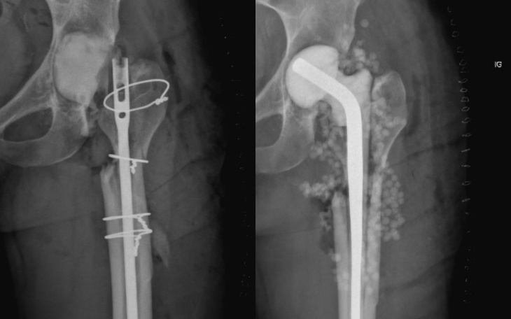 Rentgen pokazujący implant w nodze pacjenta.