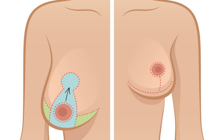 Zbiórka Redukcja biustu - zdjęcie główne