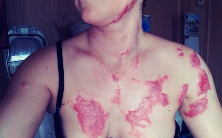 Zbiórka Oparzenie - zdjęcie główne