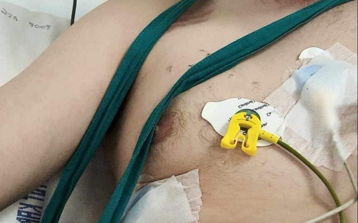 Widok na klatkę piersiową pacjenta z podłączonymi urządzeniami medycznymi.