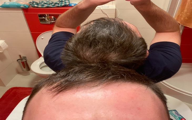 Zbiórka Przeszczep włosów Turcja - zdjęcie główne