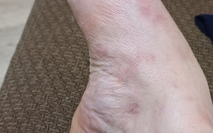 Zbliżenie na kontuzjowaną kostkę, z widocznymi siniakami.