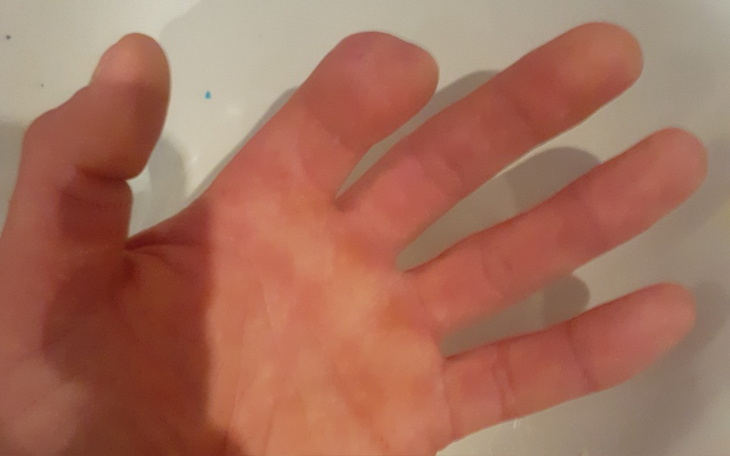 Zbiórka Zbiórka na protezę Palca - zdjęcie główne