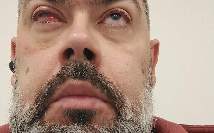 Mężczyzna z podrażnionym okiem, patrzący w górę.