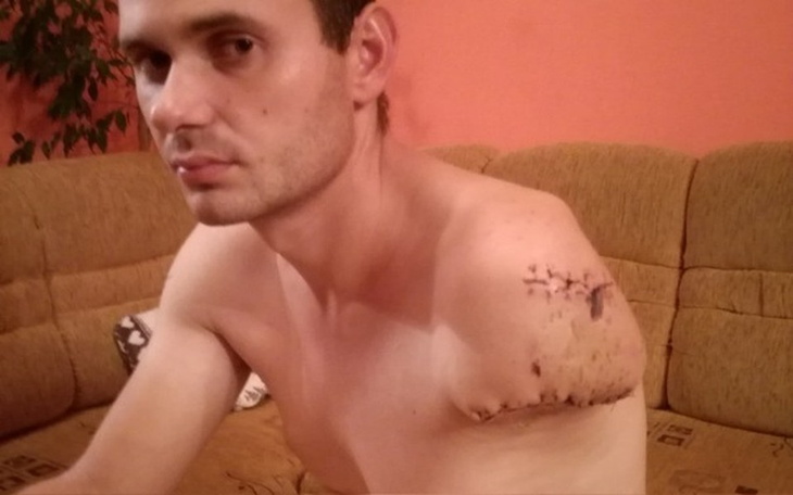 Zbiórka Bioniczna reka dla Piotrka - zdjęcie główne