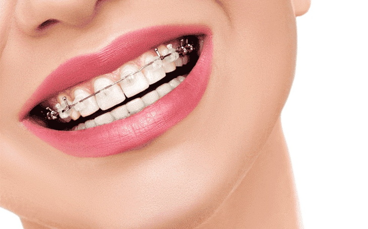 Zbiórka Na marzenieAparat ortodontyczny - zdjęcie główne