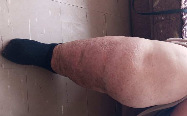 Zbiórka Na leczenie nóg - zdjęcie główne