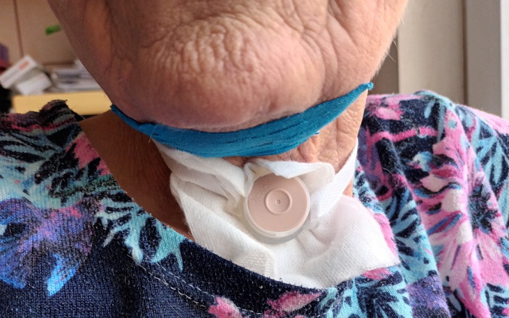 Starsza kobieta z tracheostomią na szyi.