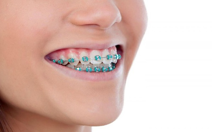 Zbiórka Na marzenie (aparat na zęby) - zdjęcie główne