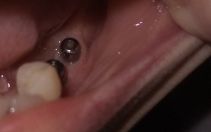 Zbiórka Na leczenie implantologiczne - zdjęcie główne