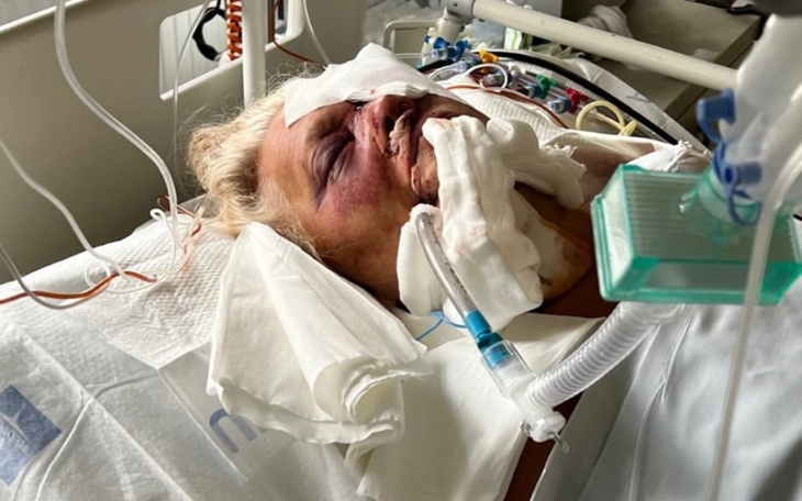 Osoba w szpitalu, z widocznymi obrażeniami na twarzy.