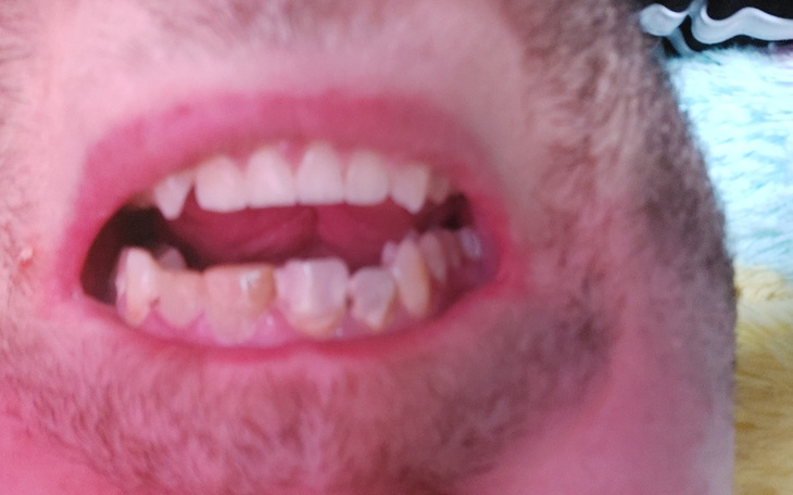 Zbliżenie na uśmiech z widocznymi zębami.
