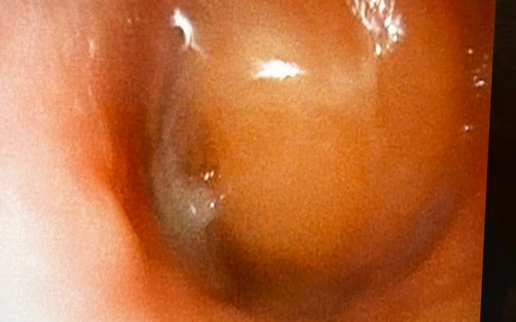 Zbiórka Operacja migdałka gardłowego - zdjęcie główne