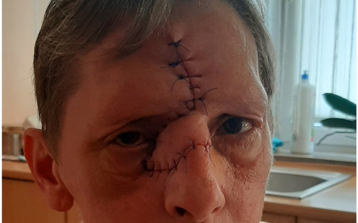 Zbiórka Pomoc po operacji raka skóry - zdjęcie główne