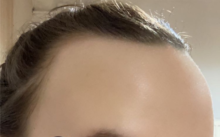 Zbiórka Na przeszczep wlosow - zdjęcie główne