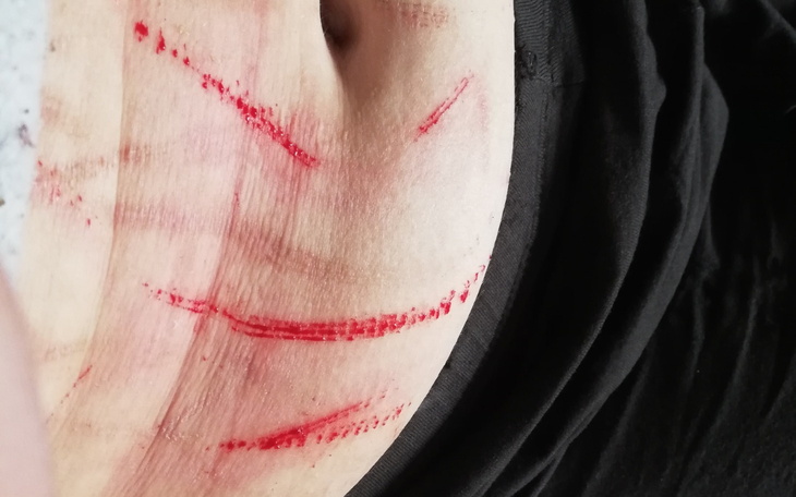 Ciało z czerwonymi zadrapaniami na skórze.