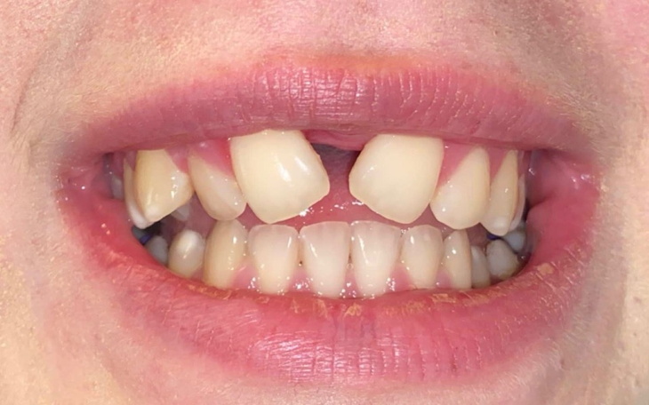 Uśmiechnięte zęby z widocznymi brakami.