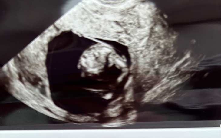 Zdjęcie ultrasonograficzne, przyszły członek rodziny.