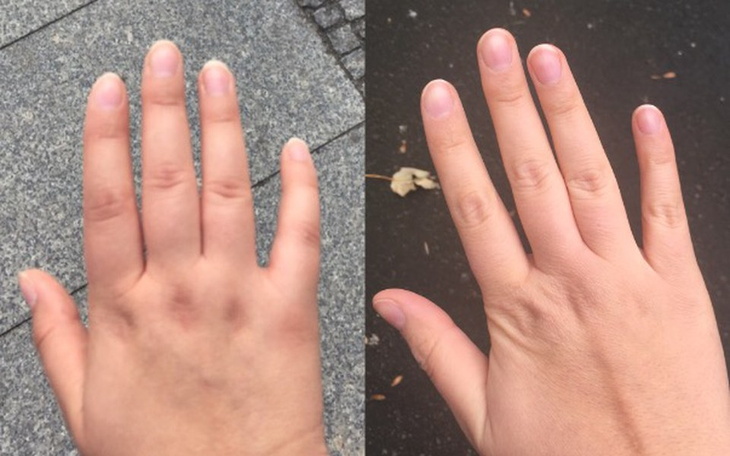 Zbiórka Na skuteczne leczenie RZS - zdjęcie główne