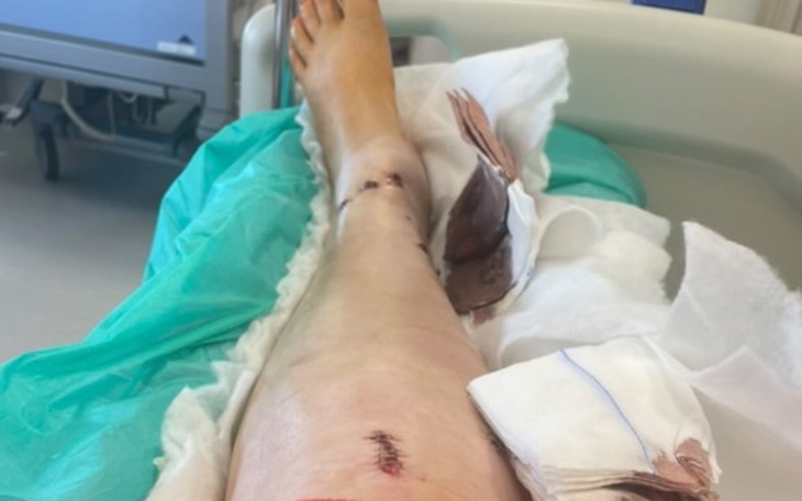 Zdjęcie nogi po operacji, z widocznymi szwami.