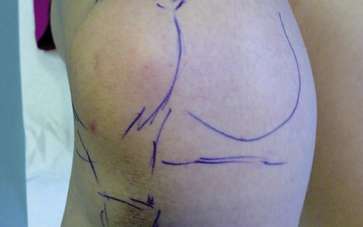 Zbiórka Leczenie rzepki - zdjęcie główne