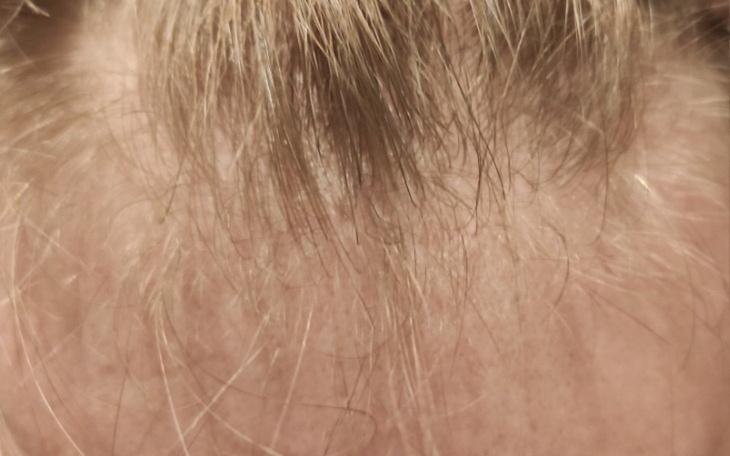 Zbiórka Na przeszczep włosów POMOCY - zdjęcie główne