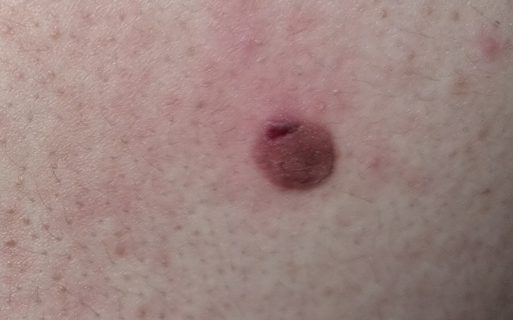 Zbiórka Na wizytę u dermatologa - zdjęcie główne