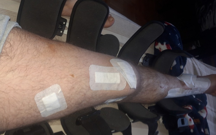 Zbiórka Na rehabilitację po wypadku moto - zdjęcie główne