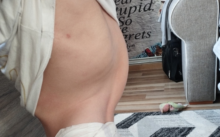 Widok na brzuch osoby, z widocznymi bliznami.