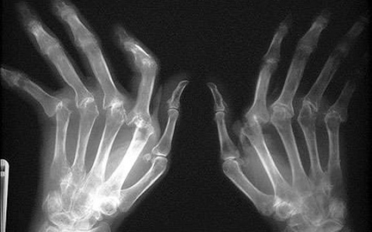 Zbiórka Reumatyzm w wieku 39 lat. - zdjęcie główne