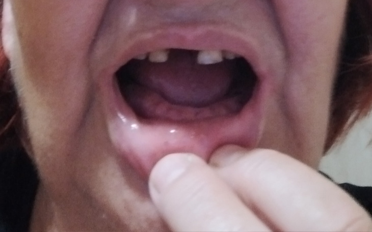 Zbiórka Leczenie paradontozy zębów - zdjęcie główne