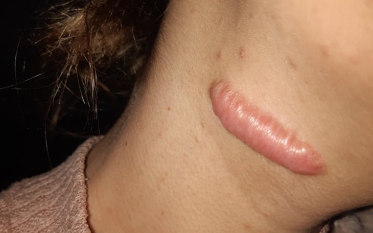 Zbiórka Zbiórka na Usunięcie Bliznowca - zdjęcie główne