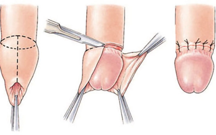 Ilustracja przedstawiająca zabieg chirurgiczny na narządach.