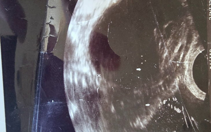 Zdjęcie ultrasonograficzne, przedstawiające rozwijający się płód.