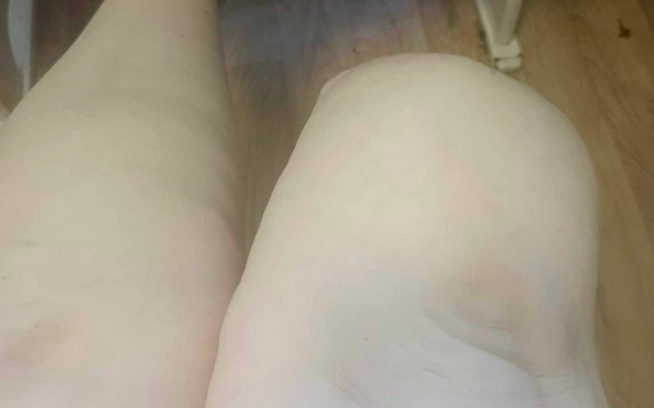 Zbiórka Pomóż Wiesi zdobyć protezę - zdjęcie główne