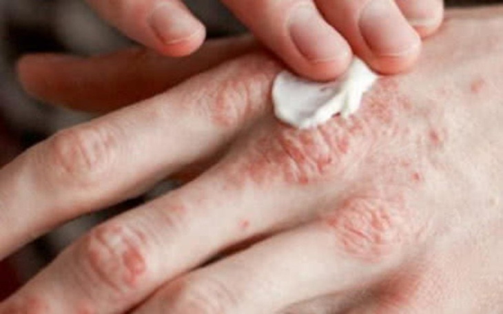 Zbiórka Atopowe zapalenie skóry-terapia - zdjęcie główne