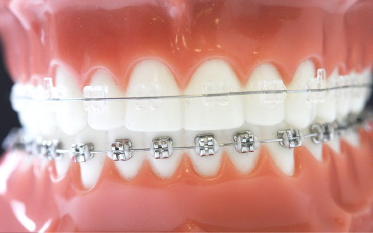 Zbiórka Aparat na zęby .. - zdjęcie główne