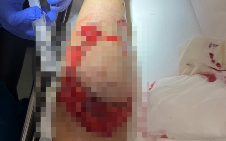 Rana na nodze, widoczna krew i opatrunek.